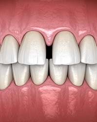 3D Illustration of gap between front teeth