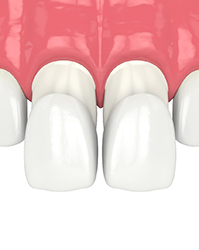 Illustration of two porcelain veneers attached to front teeth