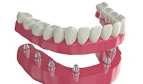 A CGI of implant dentures