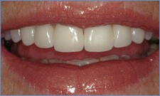 Boston Teeth Whitening