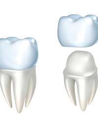 Illustration of dental crown