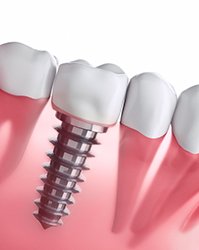 Diagram of dental implants in Boston after placement