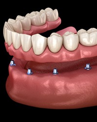 Illustration of dentures about to be snapped onto implants