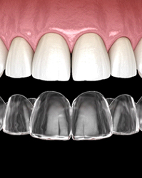 Illustration of Invisalign aligner and upper arch of teeth