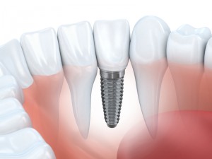 dental implant procedure