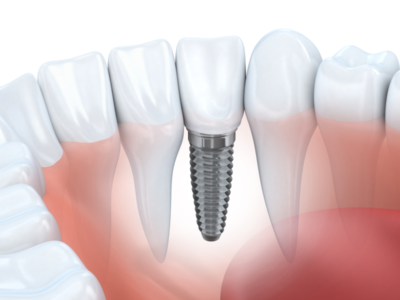 Implant Procedure: A Step by Guide