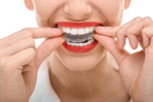 Invisalign cost