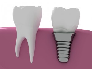 dental implants