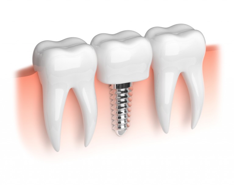 Does My Insurance Cover Dental Implants? - Kraft & Schrott Blog