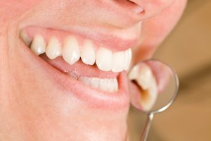 tooth colored fillings in boston restore your smile