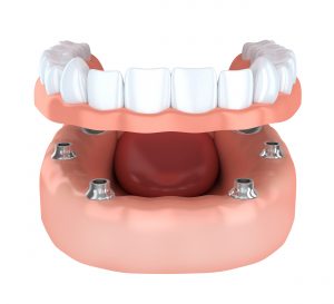 implant denture