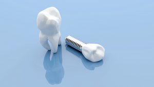 dental implant on blue background