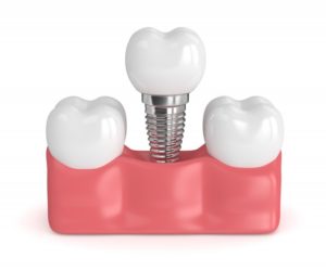 3D model of dental implant in Belmont with natural teeth