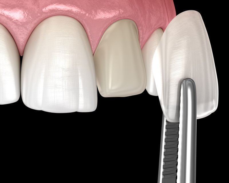 Dentist placing temporary veneer on patient’s tooth