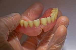 Hand holding broken dentures for the lower arch