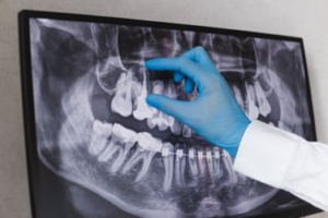 Dentist pointing out a tooth on a dental X-ray